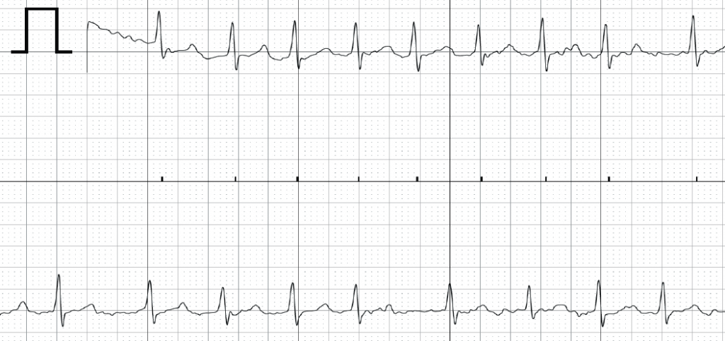 Figure 1. AliveCor electrocardiogram (ECG) demonstrating atrial fibrillation