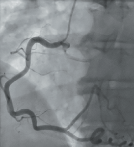 Figure 2. Left anterior oblique (LAO)view, showing the right coronary artery(RCA) arising from right coronary cusp