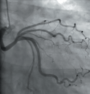 Figure 3. Right anterior oblique (RAO) view, showing left circumference artery (Cx) arising from right coronary cusp and taking a retro-aortic course