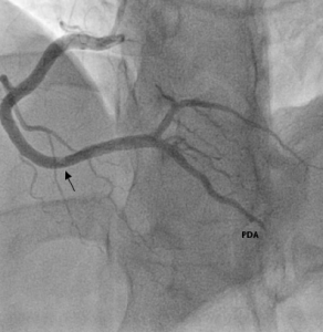 Figure 4. Large clot in the distal right coronary artery (arrowed) and filling defect in posterior descending artery (PDA)