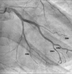 Figure 5. Almost complete resolutionof occlusions in OM2, OM3 and OM4.Small distal filling defect remains inOM1