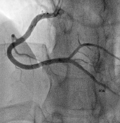 Figure 5. Almost complete resolutionof occlusions in OM2, OM3 and OM4.Small distal filling defect remains inOM1