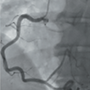 Anomalous coronary artery origin: all three arising from right coronary cusp from separate ostia