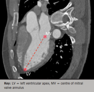 Figure 2. Multi-planar reconstruction (MPR) view of the cardiac long axis