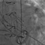 Patients with a mechanical mitral valve are potential candidates for TAVI