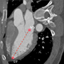 Cardiac orientation: is there a correlation between the anatomical and the electrical axis of the heart?