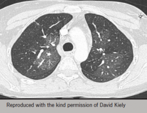 Figure 6. Mosaic perfusion pattern inchronic thromboembolic pulmonaryhypertension