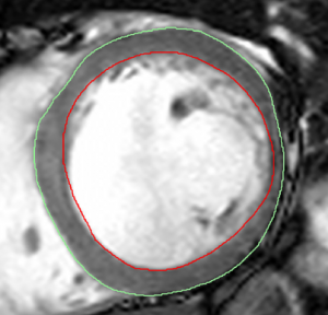 Figure 1. Measurements of left ventricle (LV) geometry on cardiac magnetic resonance (CMR). Volumes and masses were computed using the steady-state free precession short-axis stack by drawing endocardial (red) and epicardial (green) contours