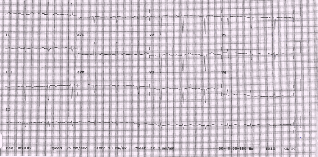 Figure 1. Electrocardiogram (ECG) findings showing Q-waves in antero-septal leads