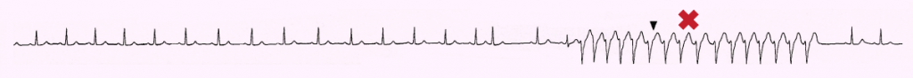 Figure 2. Polymorphic non-sustained ventricular tachycardia was seen on monitoring the patient (X)