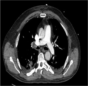 Figure 2. Post-procedure CTPA showingabsence of emboli