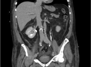 Figure 3. Post-procedure computed tomography (CT) scan showing unblocked inferior vena cava (IVC) filter