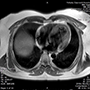 Syncope in a patient with cardiac sarcoidosis