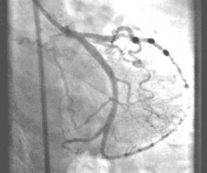 Figure 4. Right anterior oblique caudal view showing the final angiographic appearance of the left circumflex artery following insertion of two bare-metal stents