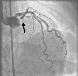 Figure 2a. Anterior-posterior cranial view showing a severe stenosis of the ostial left circumflex artery (arrow), which arises at a 90 degree angle from the left main stem