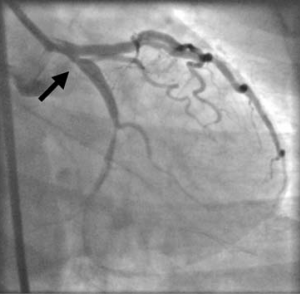 Figure 2b. Right anterior oblique caudal view showing a severe stenosis of the ostial left circumflex artery (arrow)