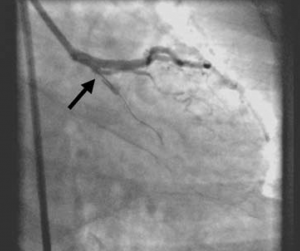 Figure 3. Right anterior oblique caudal view showing the Venture™ catheter (arrow) angulated towards the left circumflex artery allowing passage of guidewire beyond severe stenosis