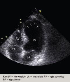 Figure 1a. Transthoracic echocardiography during the initial admission (apical four-chamber view, systole) demonstrating ballooning of left ventricular apical function as indicated by white arrows