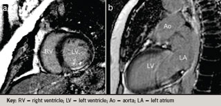 Figure 3. Delayed viability CMR scan (a) short axis and (b) two-chamber view 