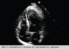 Figure 1a. Transthoracic echocardiography during the initial admission (apical four-chamber view, systole) demonstrating ballooning of left ventricular apical function as indicated by white arrows