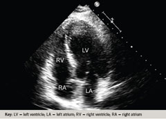 Figure 1b. Transthoracic echocardiography during the initial admission (apical four-chamber view, diastole) 