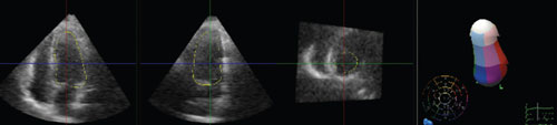 Figure 5. 3D echocardiography studies three months after the initial admission demonstrating full recovery of left ventricular function