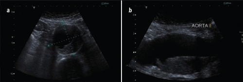 Figure 4. Tansverse (a) and longitudinal (b) ultrasound vies of an abdominal aortic aneurysm