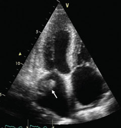 Figure 1. Transthoracic echocardiogram, apical four-chamber view, shows a large mobile 3.2 x 1.7 cm mass (arrow) protruding from the left atrial appendage, consistent with mural thrombus