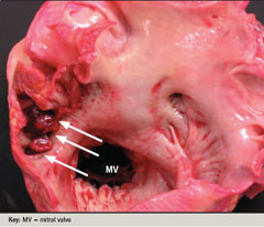 Figure 2. At autopsy, an intracardiac thrombus (arrows) was identified protruding from the left atrial appendage 