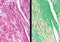 Figure 3. Microscopy of cardiac tissue from autopsy demonstrates amyloid deposition between cardiac myocytes as homogeneous light pink material (left). Sulfated Alcian blue staining shows extensive amyloid deposition as green amorphous material (right)