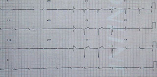 Figure 1. A 12-lead electrocardiogram in a patient with extensive AL amyloid heart disease illustrating the very low voltage limb lead complexes and Q-waves in the anterior chest leads. Note that the patient remains in sinus rhythm despite the extent of involvement