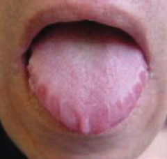 Figure 3. Macroglossia showing teeth indentations in a patient with AL amyloid disease