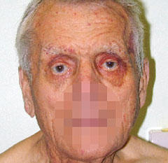 Figure 4. Peri-orbital haemorrhage (raccoon or panda eyes) occurring spontaneously is one of the classic stigmata of AL amyloidosis