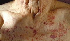 Figure 5. Petechiae over the front of the chest in an elderly patient with advanced AL amyloidosis