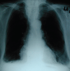 Figure 6. A chest radiograph of a patient with severe AL amyloid heart disease on echocardiography. The cardiothoracic ratio is only mildly enlarged. Bilateral small pleural effusions are seen