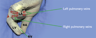 Figure 2. Posterior view: the left atrium and pulmonary veins