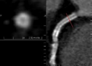 Figure 1. Multi-planar reformatted image to assess stent patency in the proximal right coronary artery