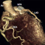 Anomalous origin of the left coronary artery from the pulmonary artery: case report and review