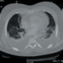 A challenging case of recurrent effusive pericarditis