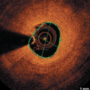 A novel method of treating stent fractures