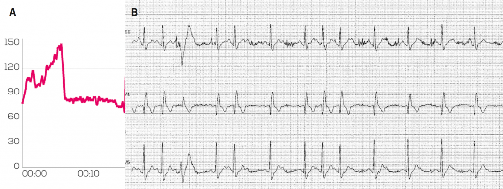 Heart rate monitors and fitness trackers: friend or foe? - The British ...