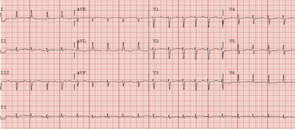 A transitory right bundle branch block - The British Journal of Cardiology