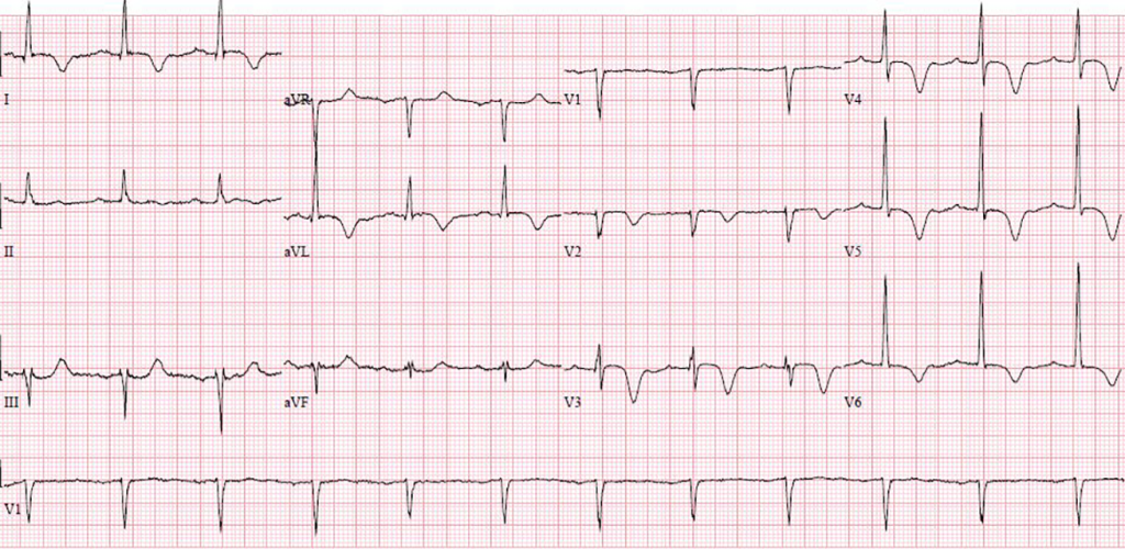 t-inverted-ekg-artinya