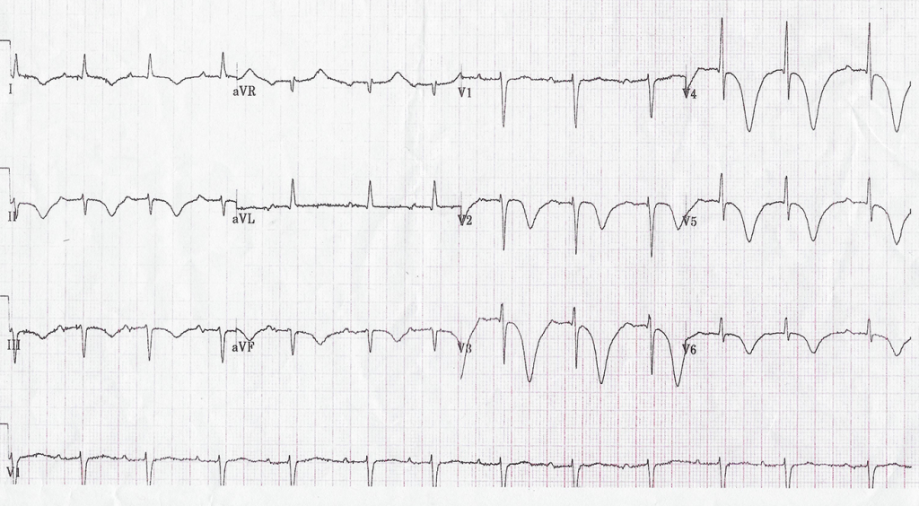 New-onset giant T-wave inversion with prolonged QT interval: shared by ...