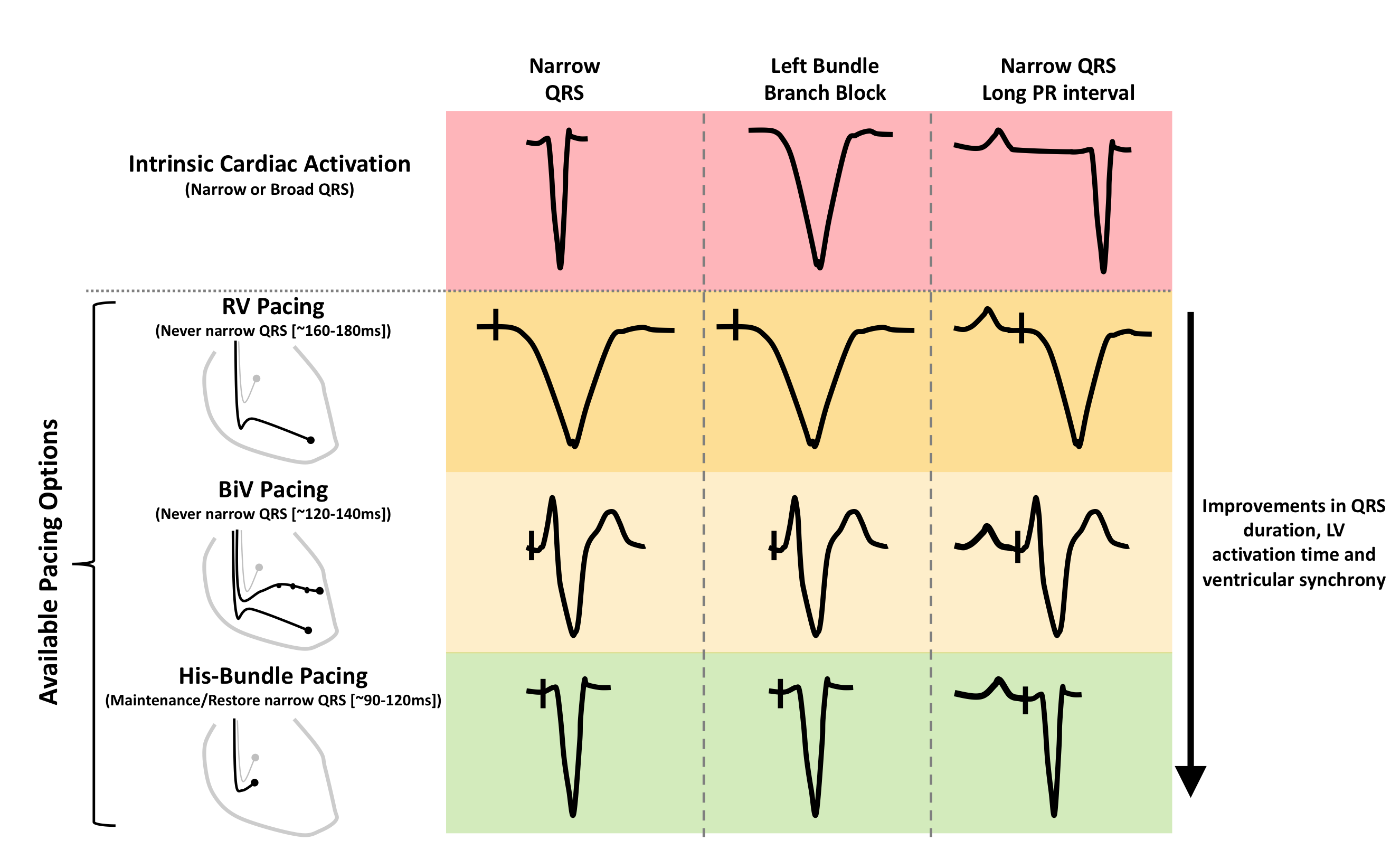 Pacing supplement: His-bundle pacing - UK experience and HOPE for the ...