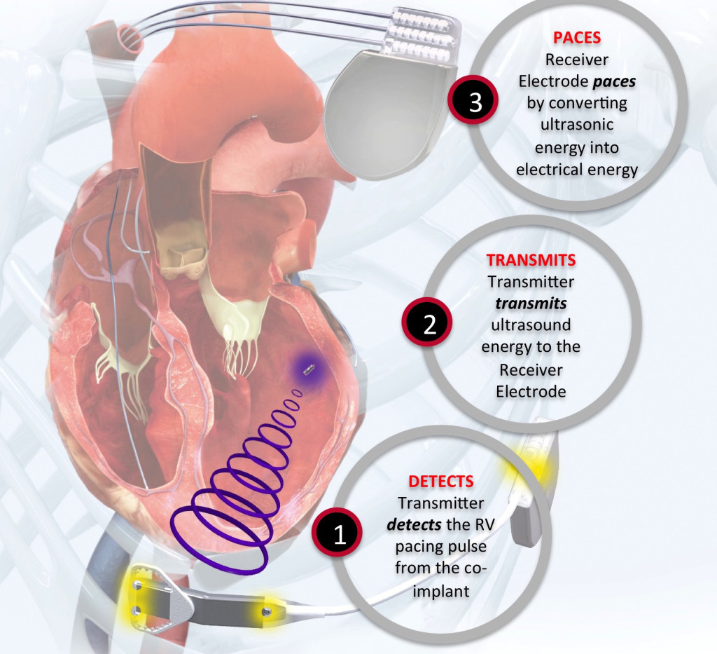 Pacing Supplement Leadless Pacing The British Journal Of Cardiology