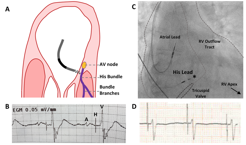 Pacing Supplement: His-bundle Pacing - UK Experience And HOPE For The ...