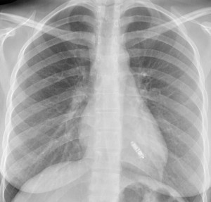 Pacing supplement: Leadless pacing - The British Journal of Cardiology