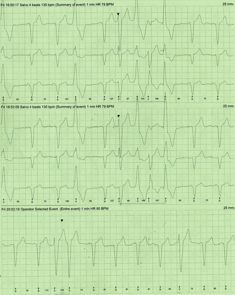 Significant suppression of premature ventricular ectopics with