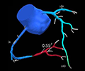 CT coronary angiography with HeartFlow<sup>®</sup>: a user’s perspective